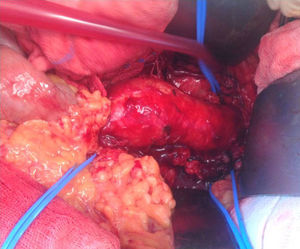 Intra-operative appearance, compatible with an inflammatory aneurysm. The inflammatory mass involved the left renal artery and grayish adenopathies were evident. The left renal artery, the right renal artery and the inferior mesenteric artery were isolated and identified by a blue Silastic® band.