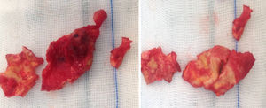 Gross appearance of some of the aneurysm wall fragments sent to histopathological analysis, infiltration of the aneurysm wall by the inflammatory mass is visible.