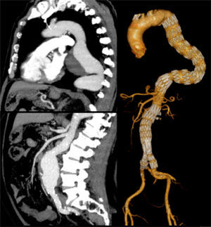 Patient with a 7cm TAA and a 6cm AAA, treated simultaneously.