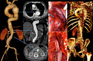 7cm type 4 thoracoabdominal aneurysm with a 6cm aneurysm of the descending thoracic aorta. The patient was treated first by OR (Crawford technique), followed by TEVAR for the TAA.