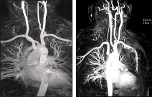 Angio‐RM demonstrando a presença de estenose na origem da artéria subclávia direita aberrante.