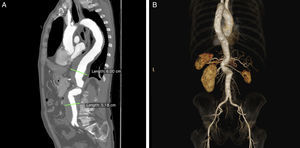 (A) Type III TAAA; (B) 3D posterior view showing severe double angulation and tortuosity of the visceral aorta.