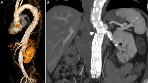 Control CTangio: (A) 3D reconstruction with patent CT and SMA; (B) patent LRA.