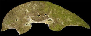 Aspecto macroscópico del hígado que muestra colestasis y zonas extensas de necrosis.