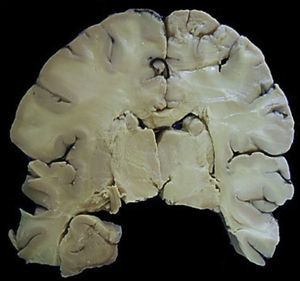 Corte coronal de cerebro donde se observa el edema acentuado y la palidez generalizada.