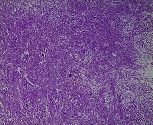 Aspecto microscópico de núcleos basales donde se identifica necrosis neuronal individual y edema acentuado del neurópilo (HE 25×).