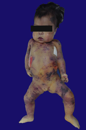 Fotografía del habitus exterior del paciente, con peso de 6,000g vs. 8,200g y numerosas lesiones purpúricas y necróticas en la piel.
