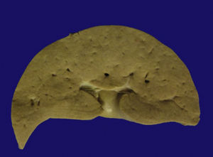 Fotografía macroscópica del hígado. Se observa de color café amarillento.