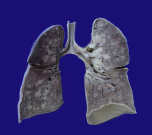 Fotografía macroscópica que muestra la superficie de corte de ambos pulmones con áreas extensas de congestión, de predominio en el lóbulo superior del pulmón izquierdo, y múltiples lesiones nodulares que miden, en promedio, 1cm de diámetro.