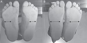 Representación de una huella plantar de un escolar con normopeso (A) y pie plano grado II de la clasificación de Denis en un escolar con obesidad (B).