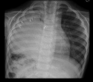 Radiografía de tórax donde se muestra radiopacidad de hemitórax derecho, tráquea y corazón en posición habitual. Se logra apreciar la carina principal y bronquio principal derecho.