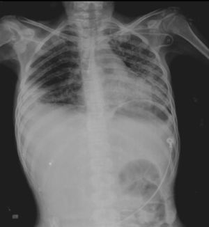 Radiografía de tórax que confirma la presencia de un infiltrado micronodular bilateral difuso con zona de paquipleuritis basal derecha, crecimientos ganglionares axilares bilaterales y hepatomegalia con patrón anormal de distribución del gas intestinal.