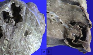 Aspecto de los pulmones al corte. Se evidencian zonas de necrosis con cavitación que corresponden al lóbulo superior izquierdo (A) e inferior derecho (B).