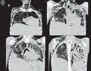 Imágenes de tomografía computada de ventana para parénquima pulmonar que muestra evolución de las lesiones nodulares, con aumento del engrosamiento alveolar y peribronquial con ruptura de estructuras alveolares que condicionan enfisema subcutáneo en la pared torácica y región cervical en forma bilateral.