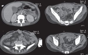 Cortes axiales de tomografía abdominal que muestra zonas de líquido perivesicular con engrosamiento difuso de la pared intestinal en forma generalizada y cambios postquirúgicos en pared abdominal.