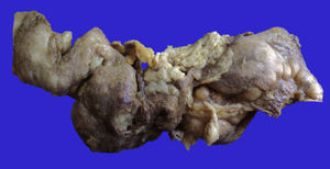 Segmento de intestino delgado que muestra serosa despulida, opaca y una zona de perforación de 2cm con necrosis y material pastoso.