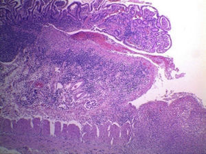 Vista panorámica del aspecto microscópico de una zona de úlcera en la mucosa que se extiende a toda la pared (HE 25x aumento original).