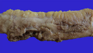 Aspecto macroscópico de un segmento de intestino delgado con una zona de perforación de 3cm de longitud y otras puntiformes.