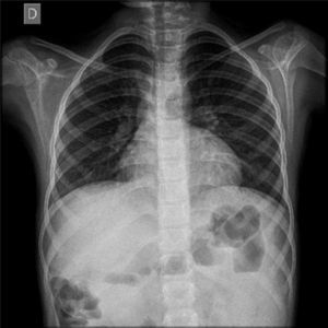 Radiografía de tórax anteroposterior en la que se observa reforzamiento parahiliar.