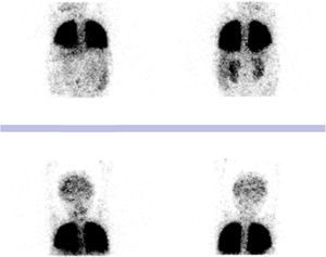 Gammagrafía pulmonar de perfusión con macroagregados de albúmina marcada con tecnecio-99m. Actividad de radiotrazador en cerebro y riñones. Cortocircuito de derecha a izquierda del 15%.