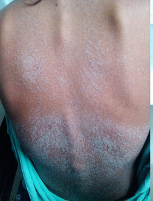 Dermatosis generalizada constituida por placas escamosas de predominio en tronco y extremidades.