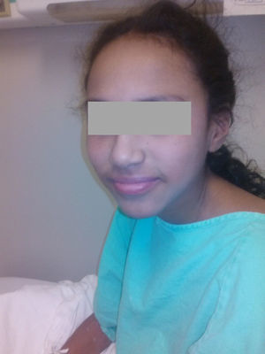 Paciente al momento de su egreso después de la administración de esteroide intravenoso, con desaparición de las lesiones descamativas.