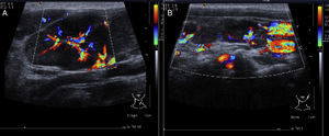 Imágenes de ultrasonido en región cervical bilateral. Se observan múltiples adenopatías a este nivel, las cuales, por el efecto Doppler, muestran aumento de flujo en su interior. A) Lado izquierdo. B) Lado derecho.