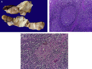 La enfermedad de Castleman, o hiperplasia de ganglios linfáticos gigantes, se representa en esta foto macroscópica, con el notorio crecimiento del conglomerado de ganglios linfáticos. En el estudio post mórtem, midieron 3 a 4cm de eje mayor cada uno (A). Hiperplasia folicular con la disposición concéntrica de linfocitos en la periferia (B). Los vasos muestran hiperplasia de la pared (C).