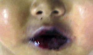 Las lesiones en labios y mucosa oral muestran ampollas y ulceración de la mucosa.