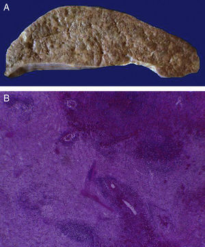 El bazo está aumentado de tamaño y peso (A). Histológicamente se observan extensas zonas de necrosis asociadas al estado de choque (B).