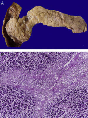En el páncreas hay extensa necrosis del tejido adiposo peripancreático (A) y del componente acinar (B).