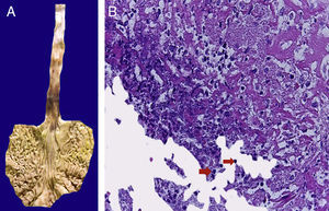 Estómago y esófago. La mucosa de ambos muestra extensa ulceración que afectan el tercio medio e inferior del esófago y la unión esófago-gástrica (A). Histológicamente, la ulcera está cubierta por fibrina, detritus celular y estructuras esféricas que corresponden a levaduras de Candida sp. (flechas), y células gigantes multinucleadas, como las observadas en el pulmón (B).
