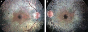 Análisis fundoscópico de ojo derecho (A) e izquierdo (B), donde se observan las anomalías características de la retinosis pigmentaria.