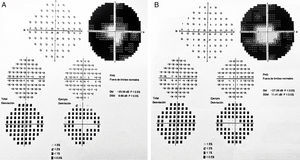 Fluorangiografía de ambos ojos (A, ojo derecho y B, ojo izquierdo) que muestra las alteraciones de esta condición.