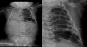 Imágenes de aspecto quístico que abarca todo el pulmón izquierdo y desplaza las estructuras del mediastino hacia la derecha.