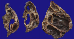 Fotografía macroscópica del lóbulo pulmonar superior izquierdo, que muestra numerosos quistes (el mayor de 6cm de diámetro).
