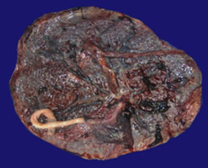 Fotografía macroscópica de la placenta.