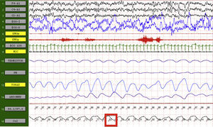 Polisomnografía del caso clínico 1. El paciente se encuentra en estadio 1 de sueño de no movimientos oculares rápidos. Se señala el nivel máximo de EtCO2 (cuadro rojo) que demuestra hipercapnia grave durante el sueño (EtCO2: dióxido de carbono exhalado).
