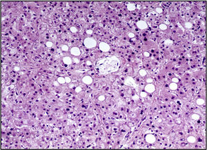 Esteatosis macrovesicular hepática.
