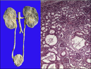 Riñones lobulados con congestión medular. La imagen microscópica muestra dilataciones quísticas en la unión cortico medular (flechas).