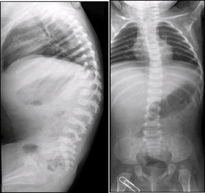 Escoliosis toráxica levoconvexa, xifosis toracolumbar y alteraciones de la morfología vertebral.