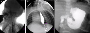 Series esófago-gastroduodenales. A) Reflujo nasofaríngeo (2009); B) cambios por funduplicatura (2011); C) sonda de gastrostomía (2012).