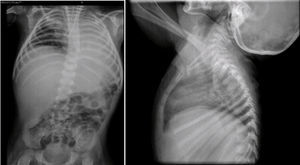 Infiltrado retículo-nodular derecho y atelectasia izquierda. Alteración morfológica de las costillas característica del síndrome de Cockayne.
