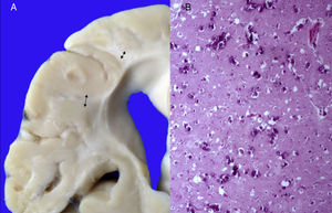 A) Encéfalo con pérdida importante de la sustancia blanca (flechas). B) Corteza cerebral con múltiples calcificaciones.