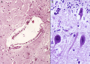 A) Vasos de la corteza cerebral con calcificaciones de su pared. B) Degeneración roja de las neuronas con microcalcificaciones.