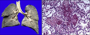 Parénquima pulmonar congestivo de coloración café oscuro. Corte histológico con hemorragia reciente y formación de membranas hialinas (daño alveolar agudo).