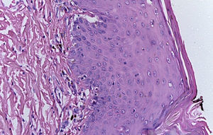 Corte panorámico de piel, unión dermo-epidérmica con melanófagos y salida de pigmento a la dermis papilar, y cambios en estrato córneo de la epidermis.