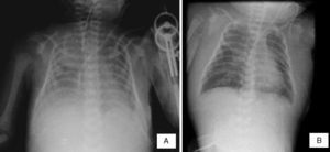 A) Se aprecia engrosamiento de tejidos blandos y borramiento de ángulos costodiafragmáticos. B) Persistencia de edema de tejidos blandos en tórax y cuello y datos de edema pulmonar.