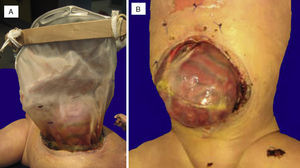 A) Silo íntegro. B) Defecto de pared de 12cm, intestino delgado fuera de la cavidad abdominal, con peritonitis extensa y coloración rojo oscuro.