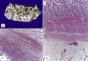 A) Asas de intestino delgado dilatadas, con meconio en su luz, edema de la pared y adherencias interasa. B) Edema de la serosa. C) Engrosamiento del peritoneo por fibrosis, infiltrado inflamatorio mixto y fibrina.